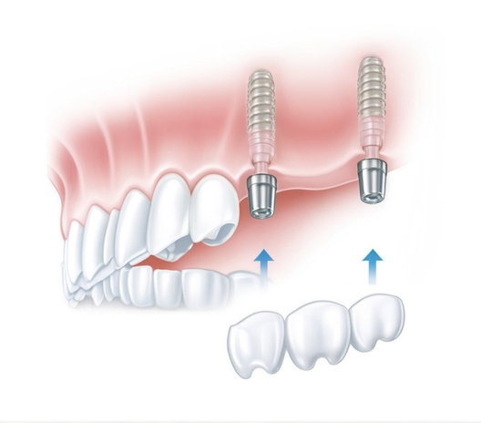 Implantat sa mostom kao zamjena za više susjednih zuba.