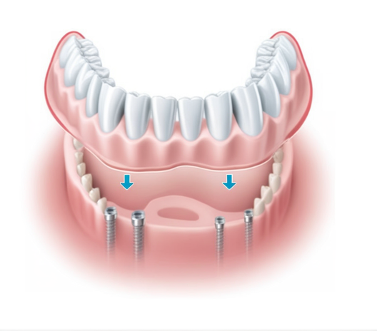 Fiksna proteza donje čeljusti