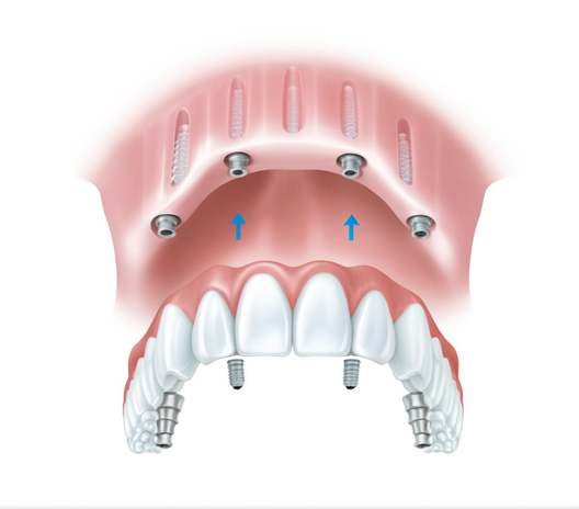 Potporna konstrukcija zuba za parcijalne proteze